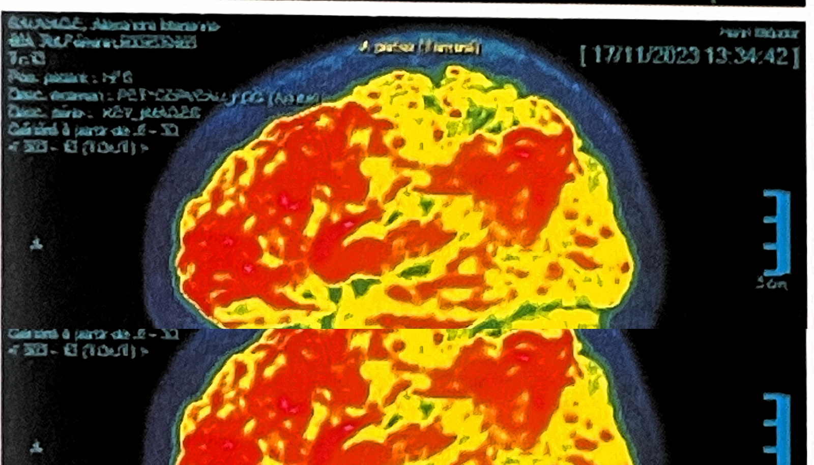 Image de TEP-scan transmise comme témoignage individuel